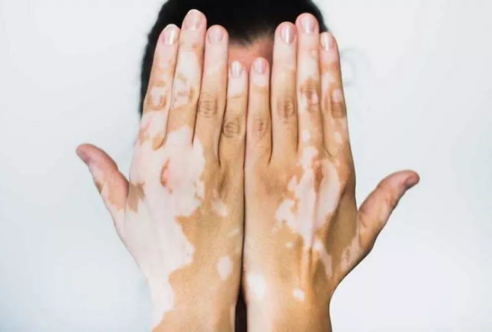 Vitiligo: piden consultar con la aparición de primeras manchas